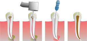 endodoncia salvar dientes
